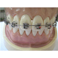 orthodontic self-ligation bracket