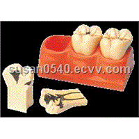Dental Caries Dissected Teeth Model