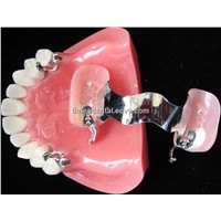 denture with attachments,dental prosthesis with attachments