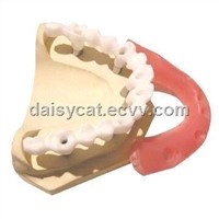 screw-retained implant