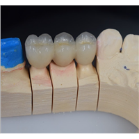 Zirconia High Translucent - All Ceramic Dental Crowns &amp;amp; Bridge