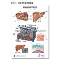 3D Medical Anatomical PVC Chart - Liver Disease
