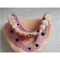Dental Implant Framework