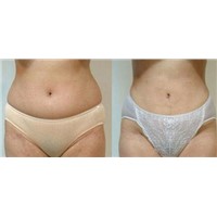 Korean double-fold,Korean wonderful,Collagen injections,Liposuction slimming,Korean rhinoplasty