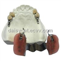 Precision Attachment with denture