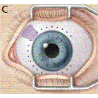 Refractory Glaucoma Laser Treatment